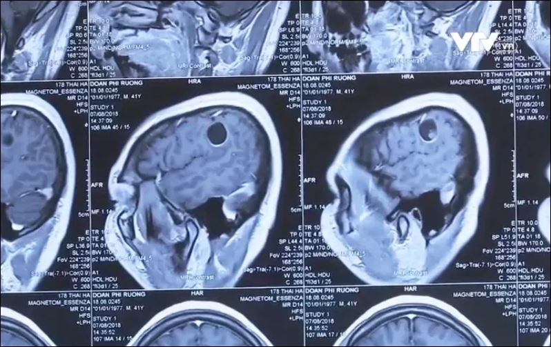 Cần đề phòng nhiễm sán não